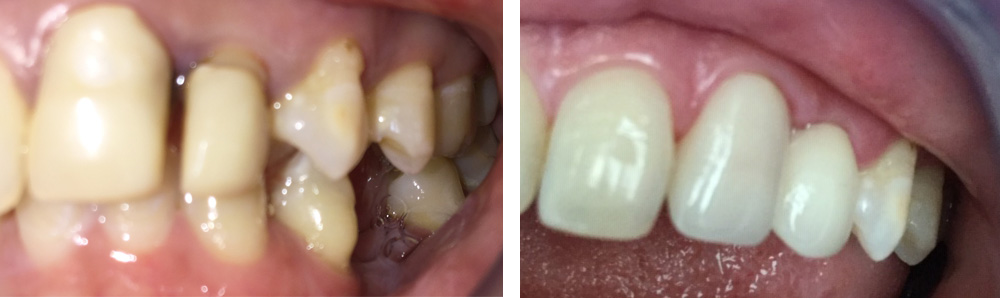 Before & After - 	Belva Dental, Daly City Dentist