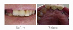 Before & After - 	Belva Dental, Daly City Dentist