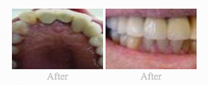 Before & After - 	Belva Dental, Daly City Dentist