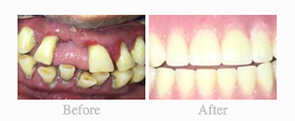 Before & After - 	Belva Dental, Daly City Dentist