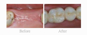 Before & After - 	Belva Dental, Daly City Dentist