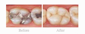 Before & After - 	Belva Dental, Daly City Dentist