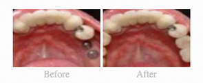Before & After - 	Belva Dental, Daly City Dentist