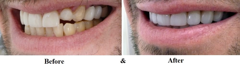 Before & After - 	Belva Dental, Daly City Dentist