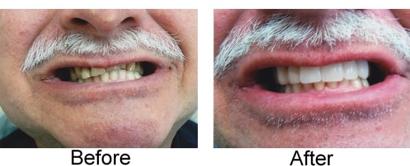 Before & After - 	Belva Dental, Daly City Dentist