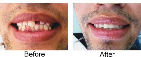 Before & After - 	Belva Dental, Daly City Dentist