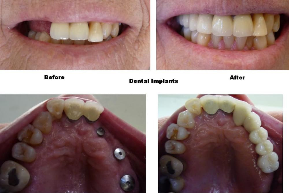 Before & After - 	Belva Dental, Daly City Dentist