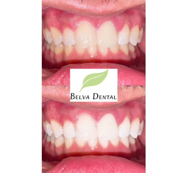 Before & After - 	Belva Dental, Daly City Dentist