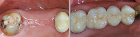 Dental Bridges - Belva Dental, Daly City Dentist