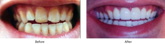 Dental Veneers - 	Belva Dental, Daly City Dentist