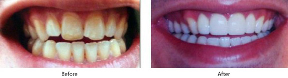 Dental Veneers - Belva Dental, Daly City Dentist