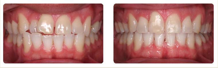 Invisalign - Belva Dental, Daly City Dentist