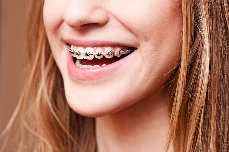 Orthodontics - 	Belva Dental, Daly City Dentist