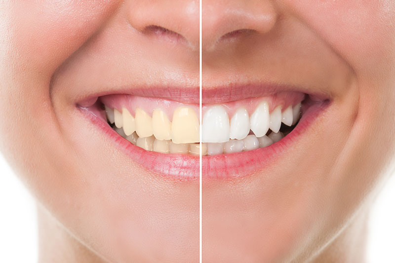 Teeth Whitening - 	Belva Dental, Daly City Dentist