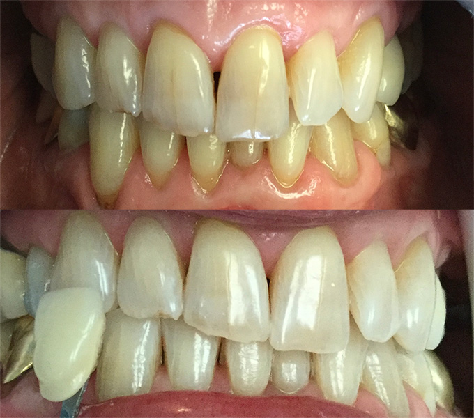 Before & After - 	Belva Dental, Daly City Dentist