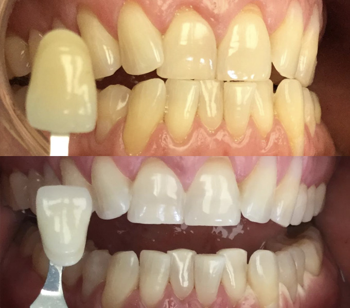 Before & After - 	Belva Dental, Daly City Dentist